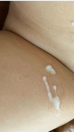 Close-up of skin with white substance on it.