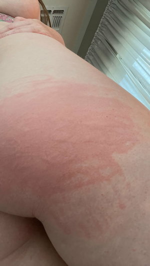 Curvy woman bare buttocks with red rash indoors.