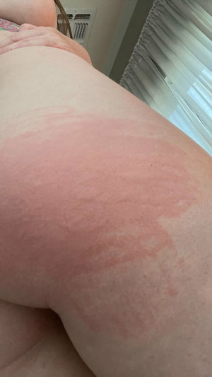 Curvy woman bare buttocks with red rash indoors.